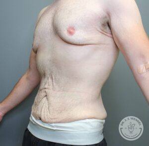 Oblique angle of torso with excess skin before tummy tuck