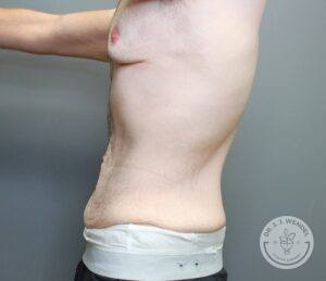 Side profile of body with excess skin before tummy tuck