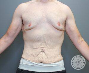 Body before tummy tuck with excess skin around lower torso