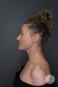 left side profile view of woman's face after Morpheus8 treatment