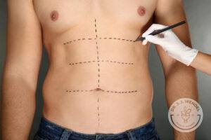 man's torso with dashed lines on abdomen