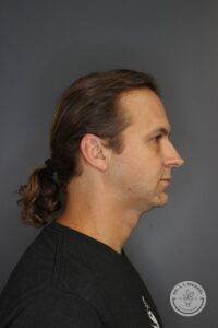 right side view of male before Volux and Voluma injections to jawline