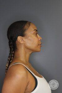 right side view of woman after Volux and Voluma injections