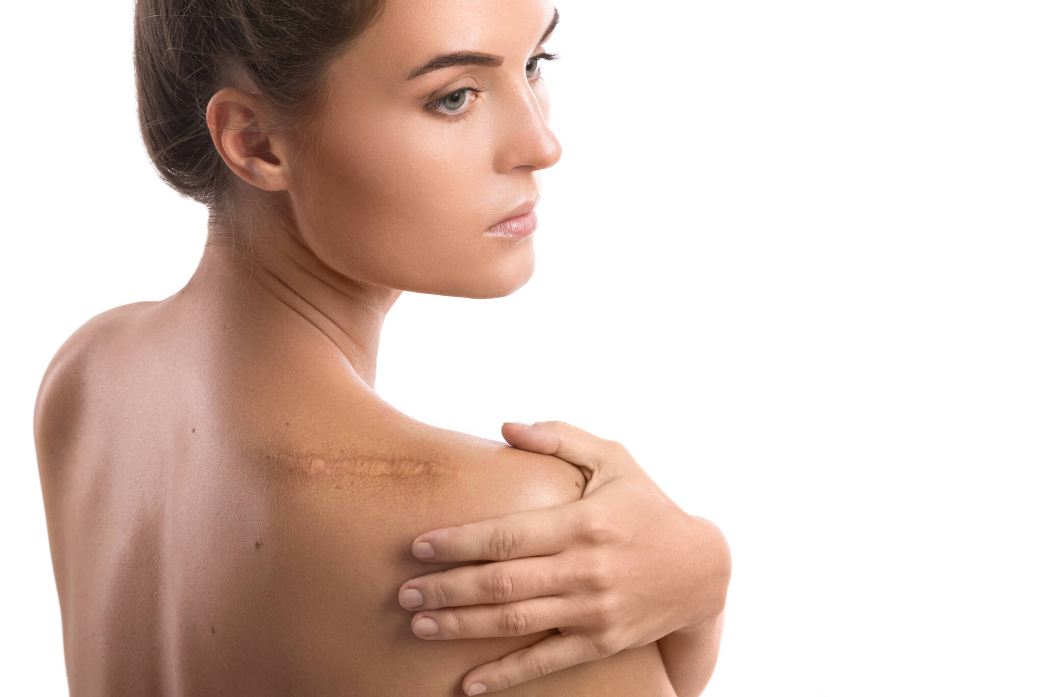 Woman posing with Scar on her shoulder, thinking about innovative scar treatments.