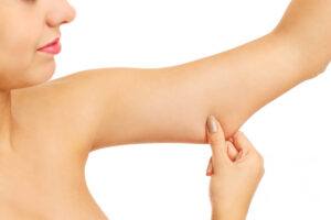 Woman pinches loose skin on upper arm