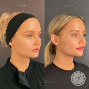 Before and after images: Right oblique view of woman who received jawline filler and lip injections