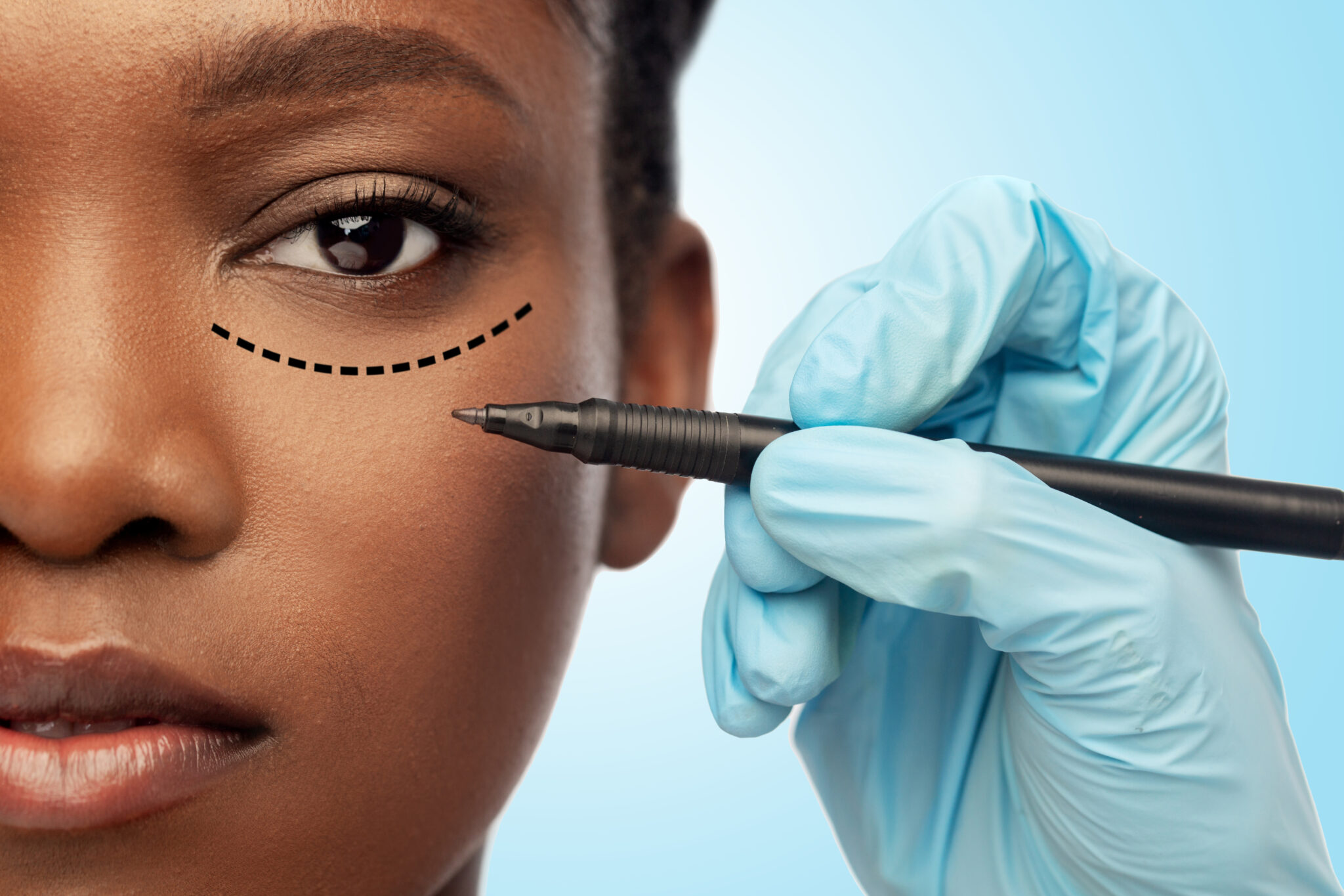 woman having lines for a blepharoplasty drawn