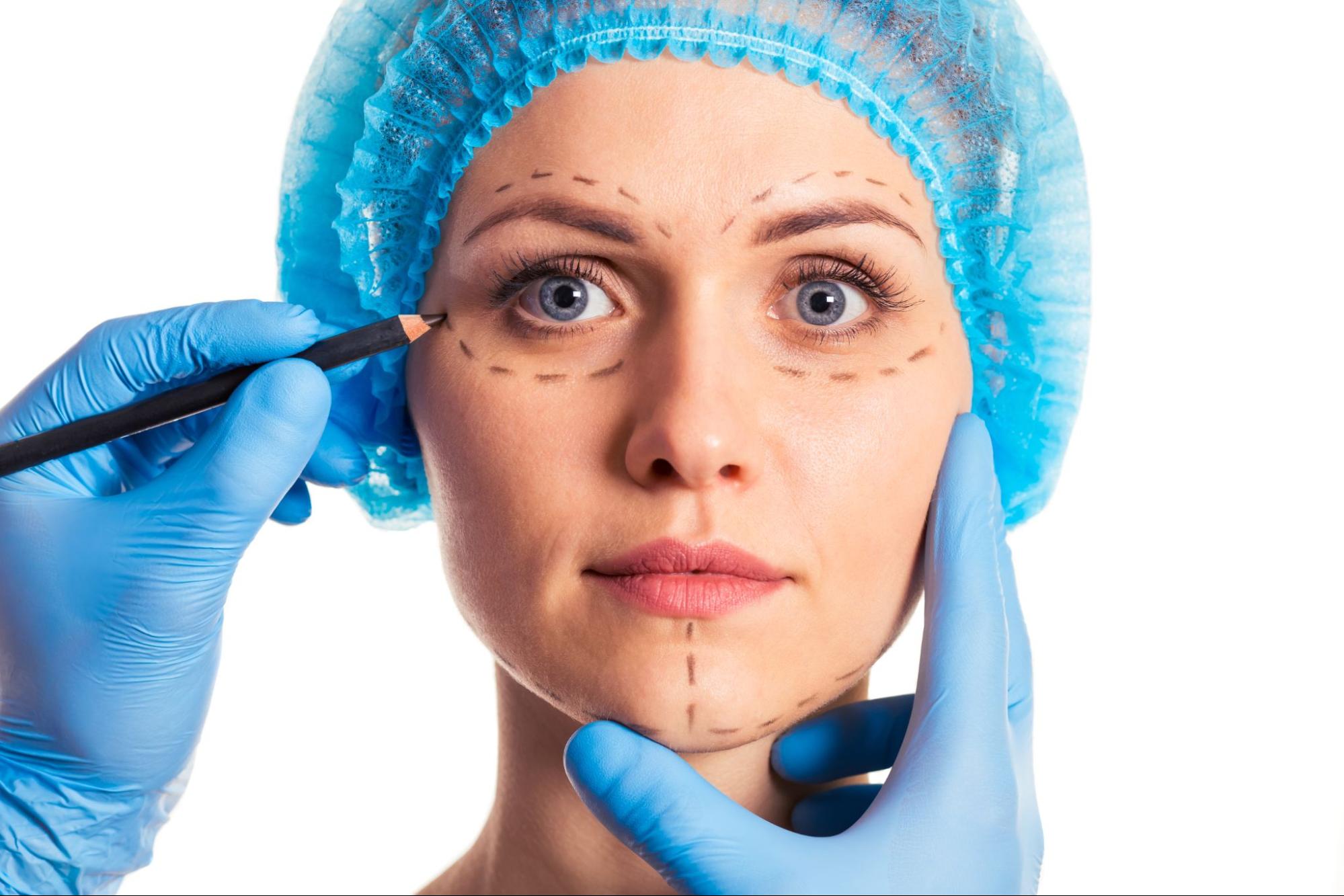 Patient with surgical markings on mid-face and under-eye area during consultation for a mid-face lift procedure
