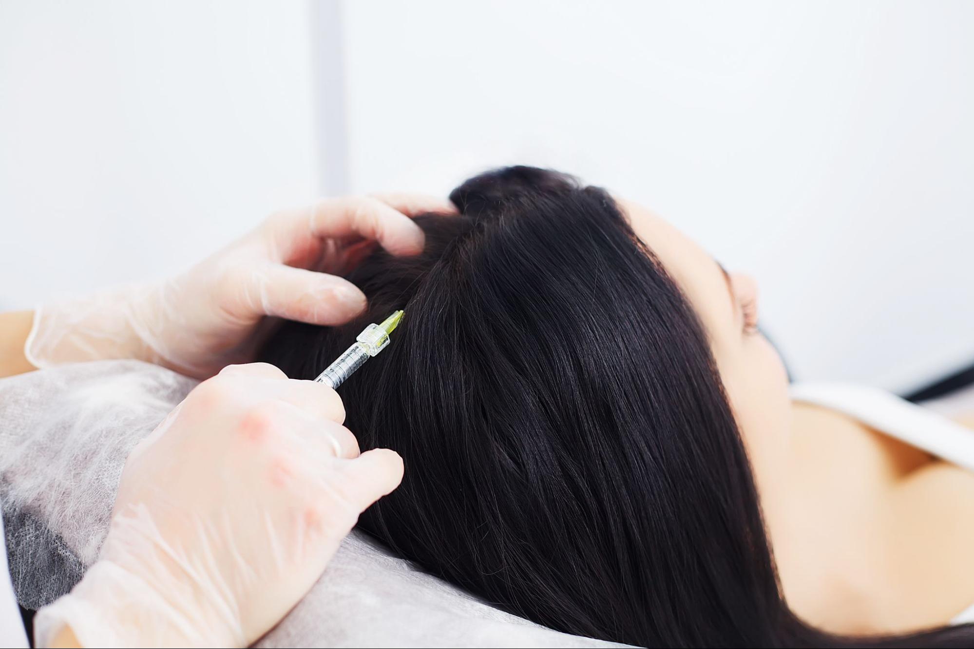 Woman receiving non-surgical hair restoration treatment with scalp injection for hair thinning
