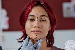 Young woman with facial markings for cosmetic surgery consultation, illustrating growing interest in deep plane facelifts among younger patients