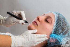 plastic surgeon marking the lower face and neck before a rejuvenation procedure
