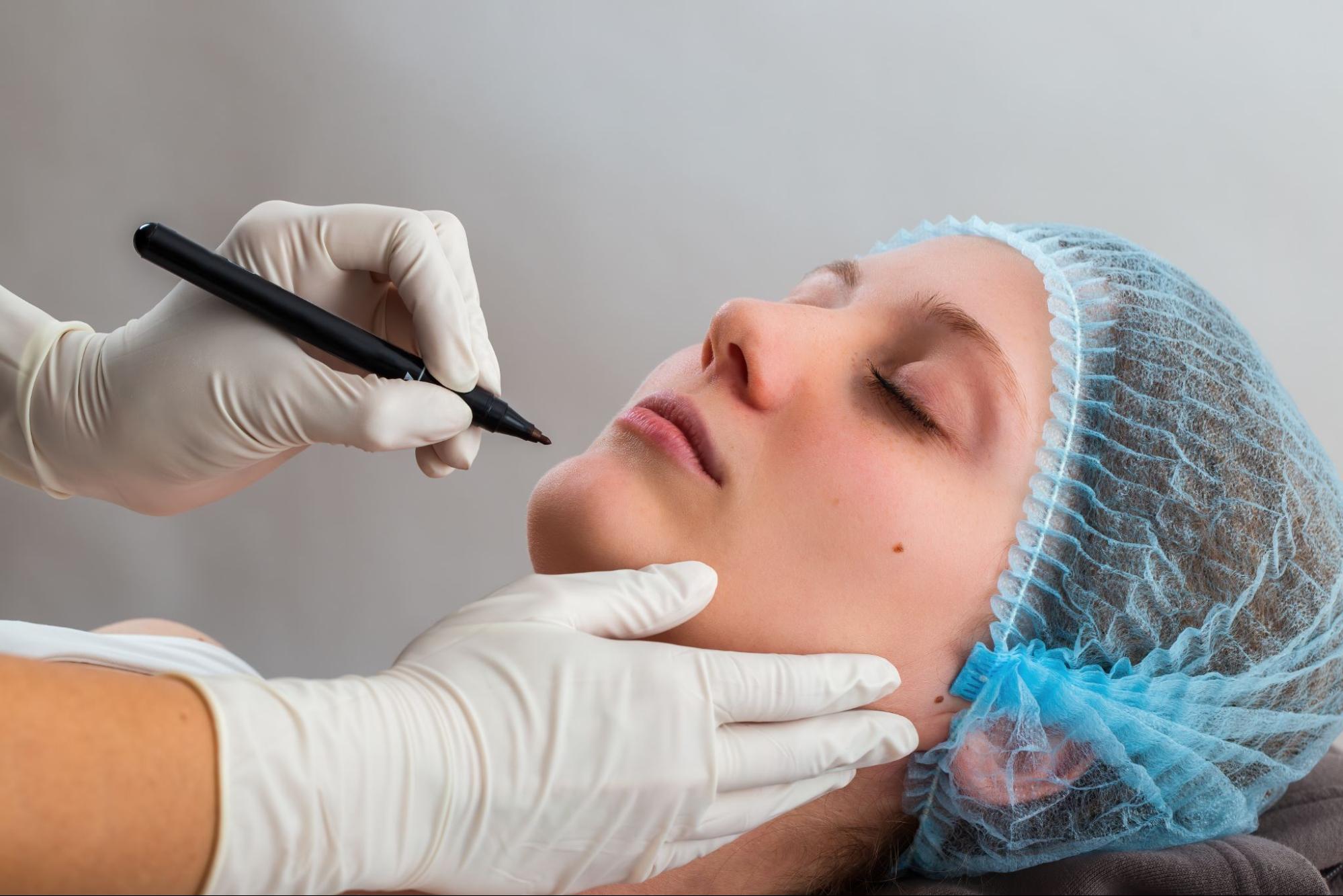plastic surgeon marking the lower face and neck before a rejuvenation procedure