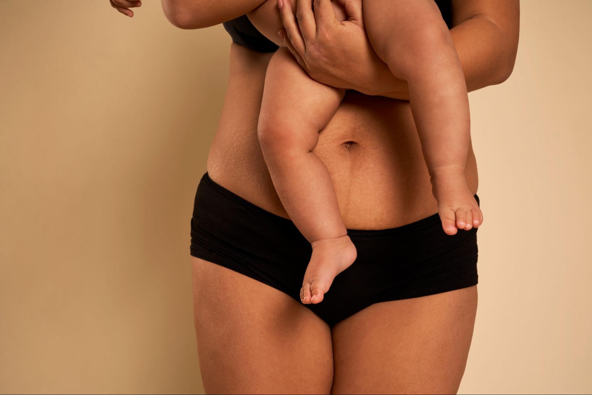 Mother holding baby showing postpartum abdomen before mommy makeover procedure