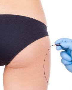 Plastic surgeon marking the buttocks area before a butt lift body contouring procedure