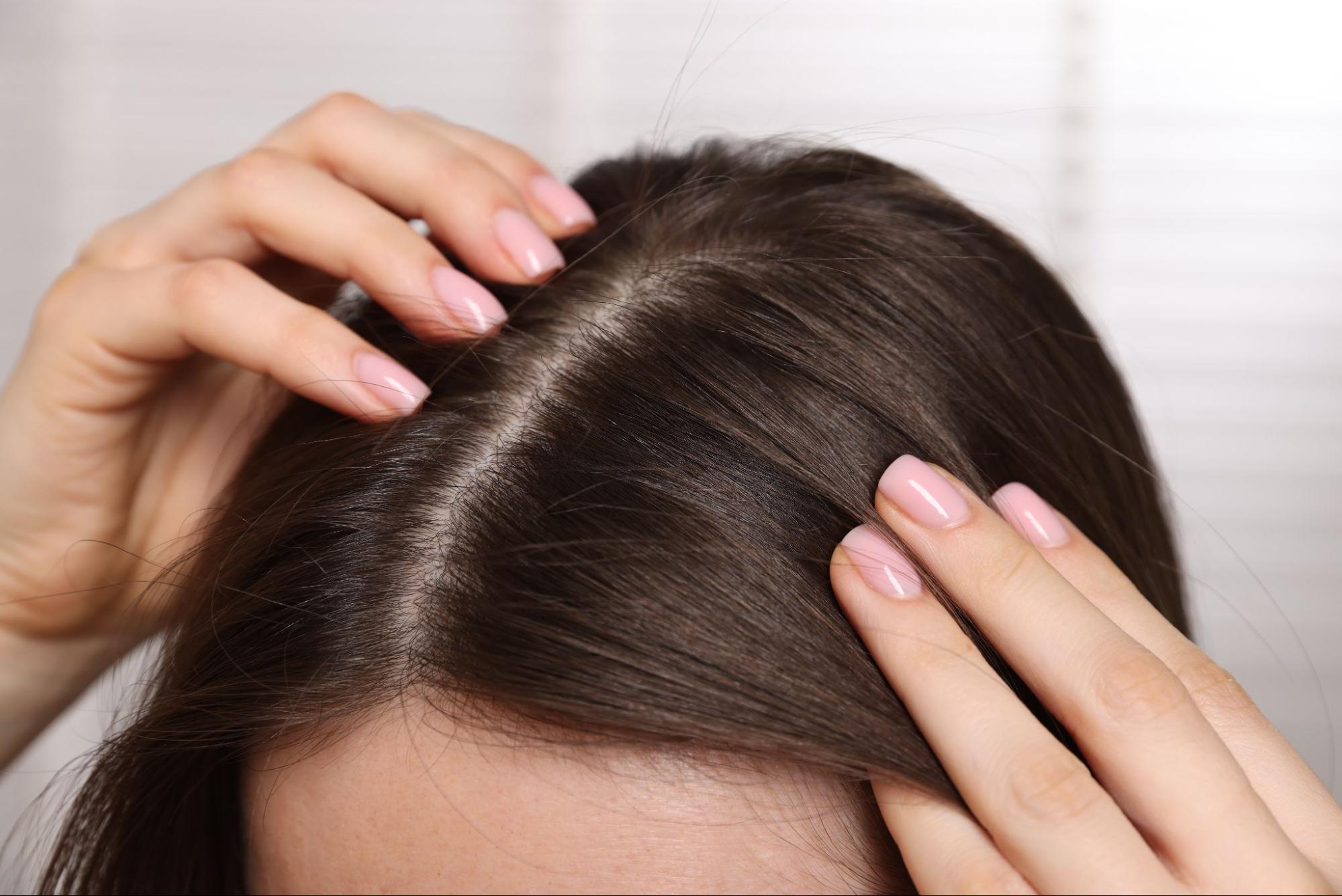 Person showing thinning hair along the scalp part before PRP treatment for hair loss