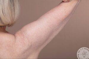 Close-up of loose, sagging skin on the upper arm, illustrating skin laxity that an arm lift can address.