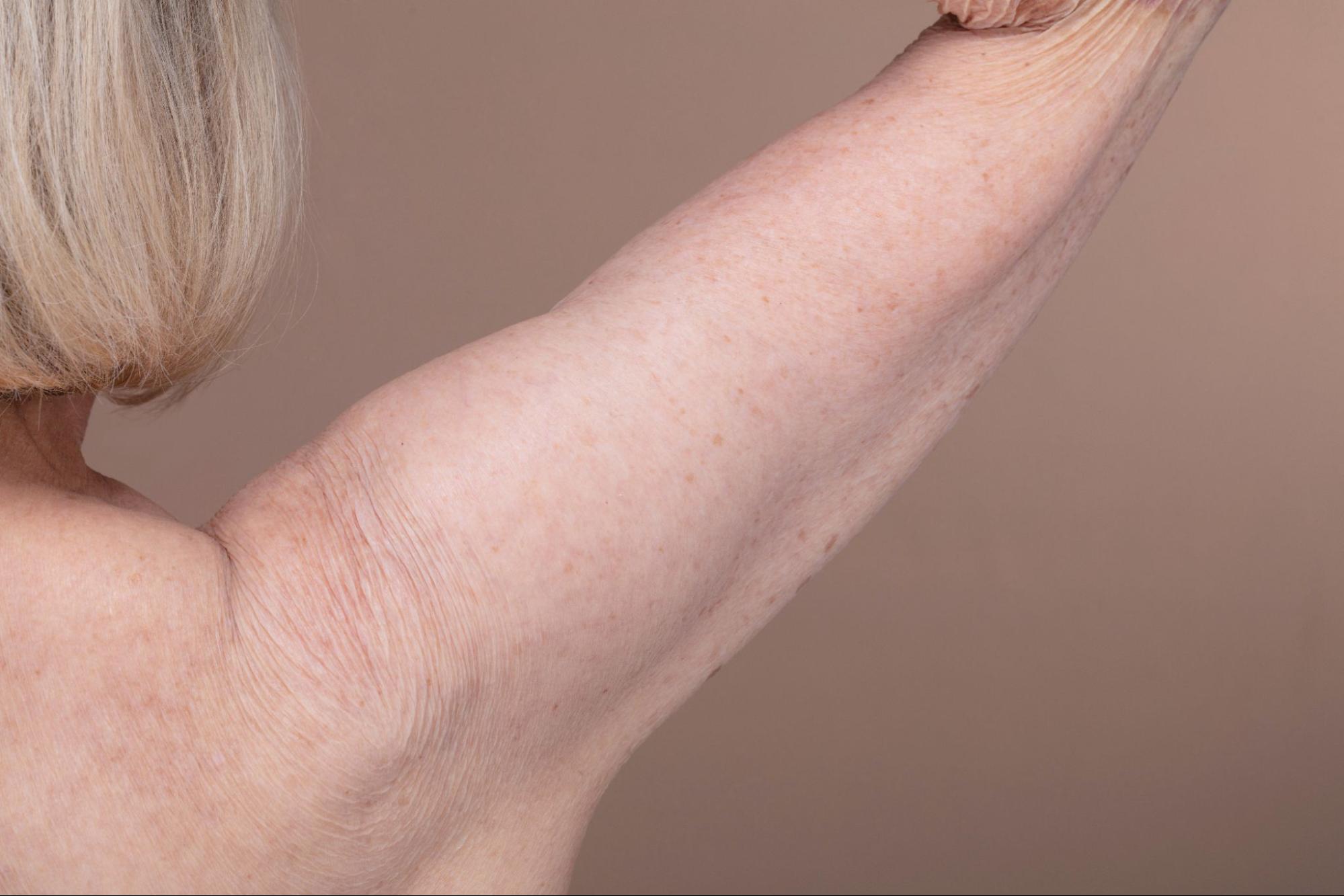 Close-up of loose, sagging skin on the upper arm, illustrating skin laxity that an arm lift can address.