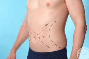 Man's abdomen with surgical markings illustrating liposuction body contouring