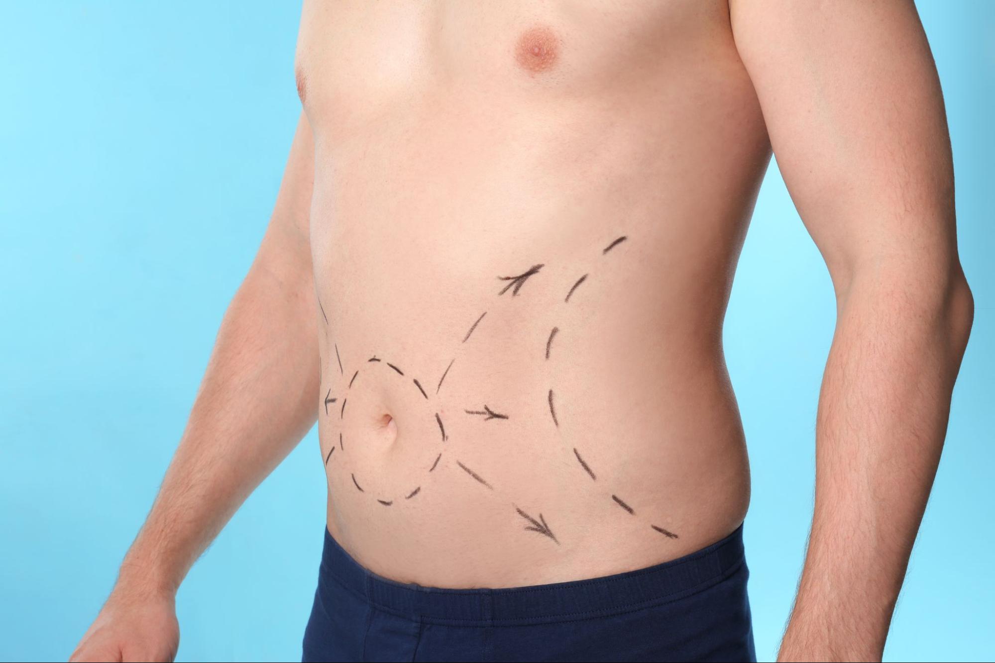Man's abdomen with surgical markings illustrating liposuction body contouring