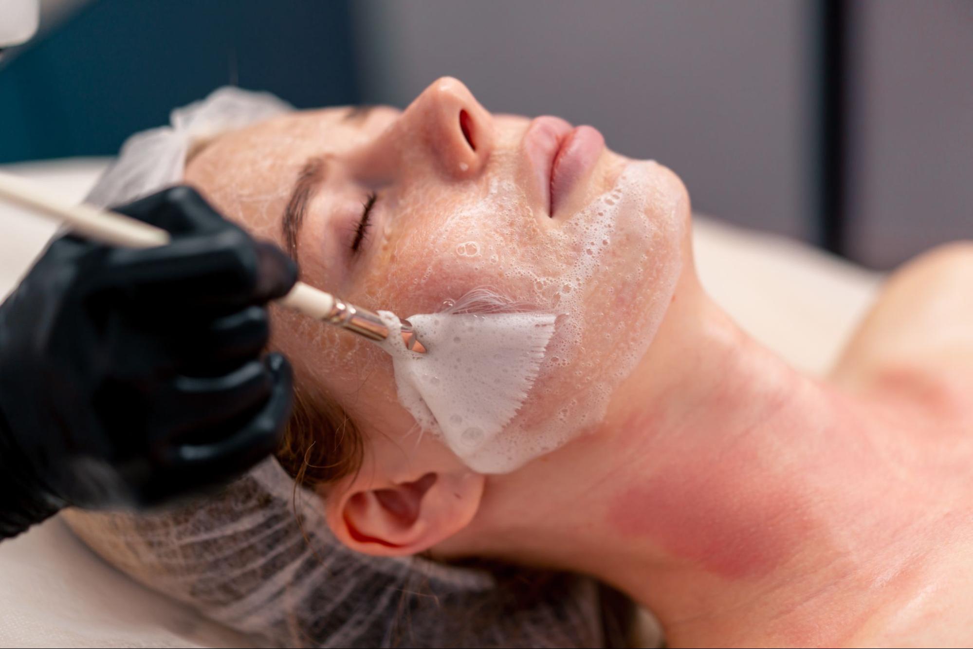 Woman receiving a chemical peel facial treatment