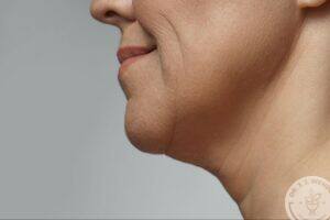 Side profile showing fullness beneath the chin associated with facial fat