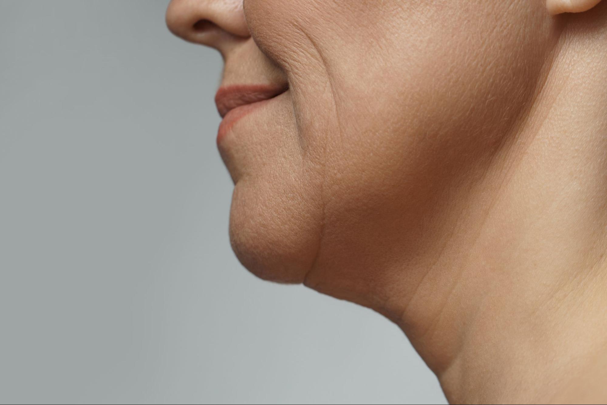 Side profile showing fullness beneath the chin associated with facial fat