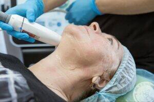 A patient receiving a radiofrequency microneedling treatment on her cheek using a handheld device.