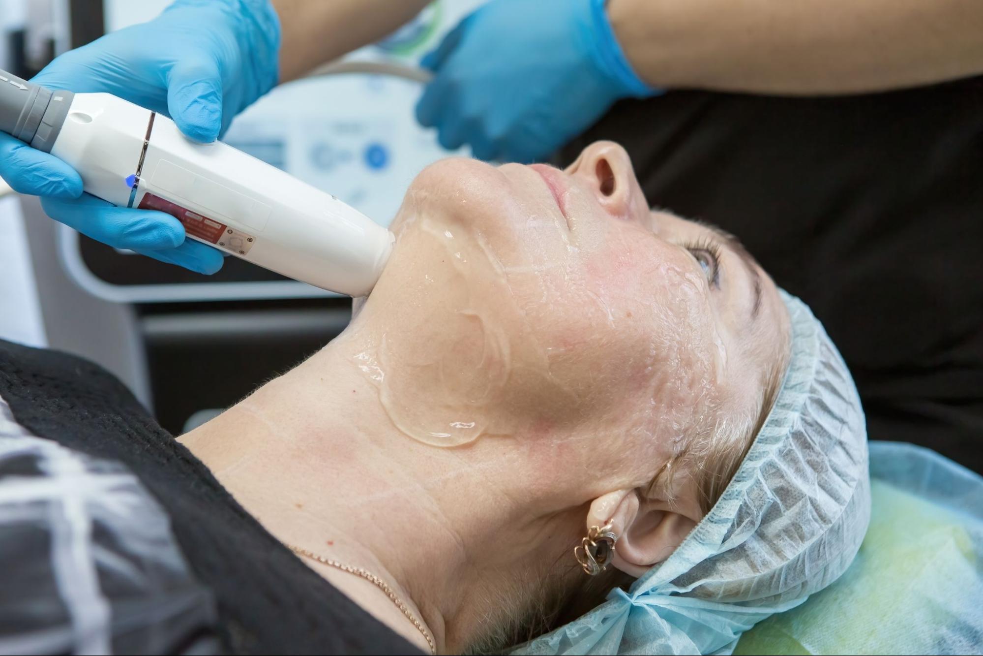 A patient receiving a radiofrequency microneedling treatment on her cheek using a handheld device.