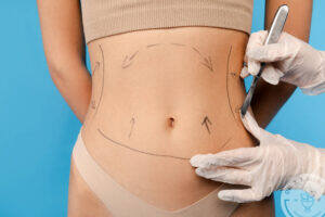 Plastic surgeon marking a woman’s abdomen with surgical lines before a tummy tuck procedure