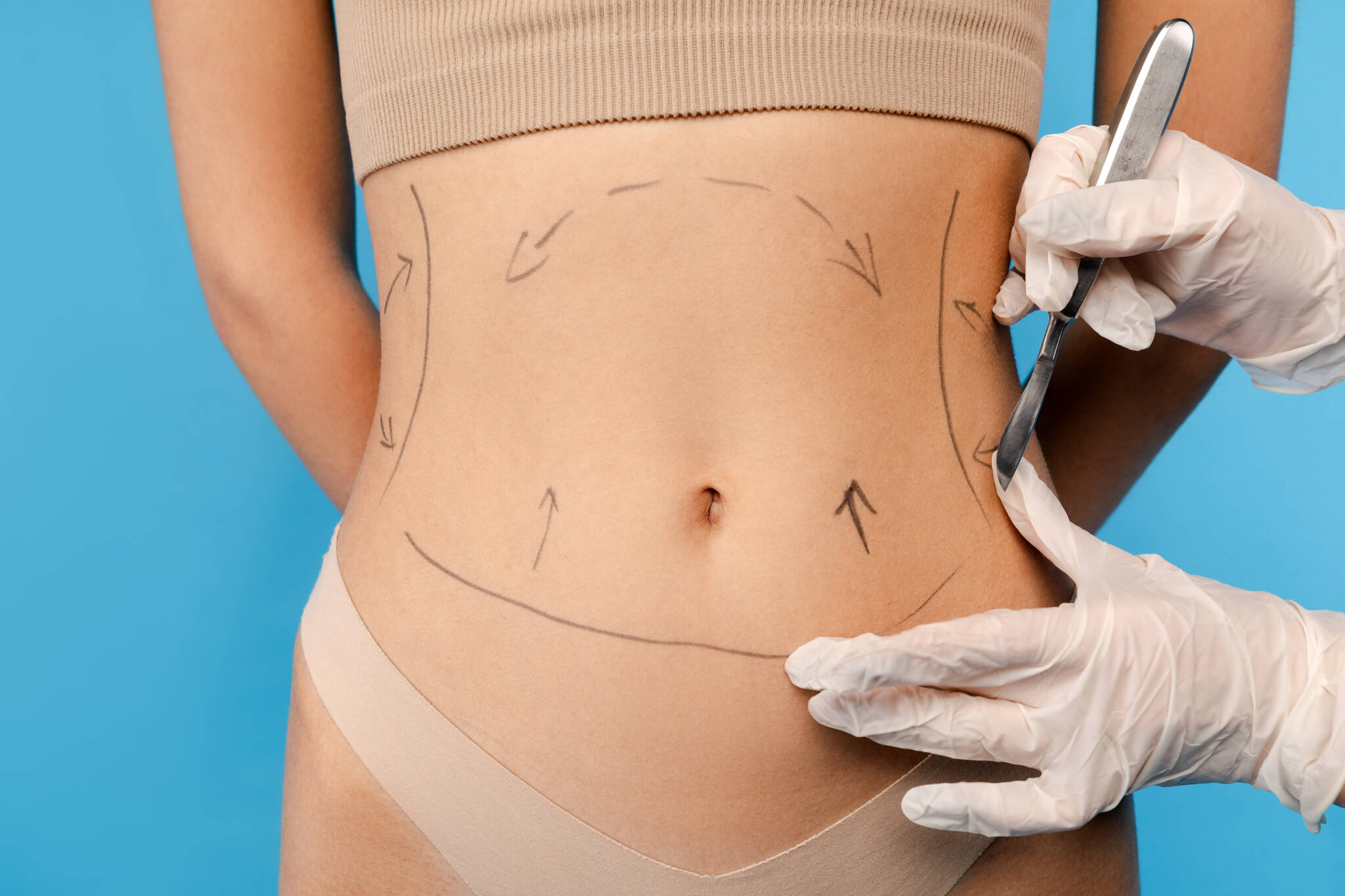 Plastic surgeon marking a woman’s abdomen with surgical lines before a tummy tuck procedure